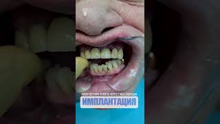 Новая верхняя челюсть через 2 часа операции. New upper jaw after 2 hours of surgery.