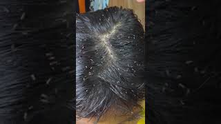 Picking a thousand of lice on hair - How to remove lice