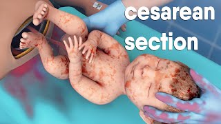 A cesarean section | known as a C-section |  is a surgery to deliver a baby via