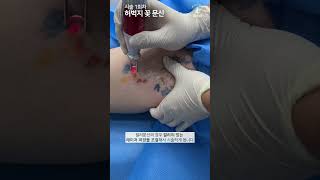 허벅지 컬러 꽃 문신(타투)제거 ASMR - ALL 수면마취 [Laser Tattoo Removal]