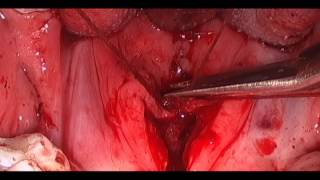 pflap Combined Inset Nasal and Oral Lining