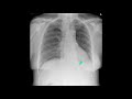 Left lower lobe collapse - the most divisive of all radiology exam cases?