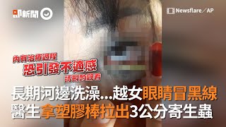 越南媽媽眼睛冒黑線　醫生拿塑膠棒拉出3公分寄生蟲｜恐怖