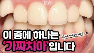 어떤 치아가 '가짜치아', 보철물 일까요?