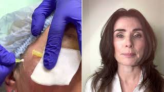 Crows Feet Wrinkle Removal with PDO Threads