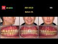 cii adult tx with ma：mandibular advancement u0026 centric relation｜【chris chang ortho】cc639.