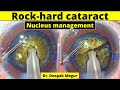 Brown rock hard cataract , Nucleus management - Dr. Deepak Megur