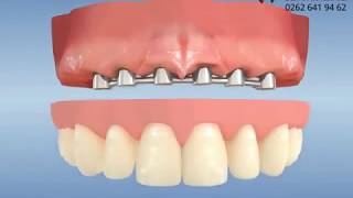 Implant supported bar overdenture