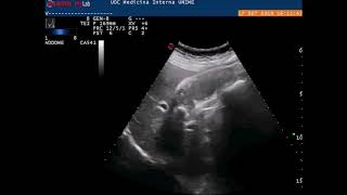 Gallbladder empyema and stones ultrasound