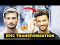 Non Surgical Hair Replacement - Hair Patch/Wigs For Men In India