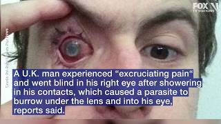 Man goes blind in right eye after contracting parasitic infection from showering in contacts