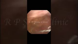 Kidney Stone Removal by RIRS