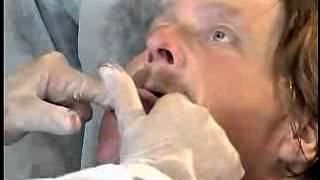 Complete Denture Procedure ; 07 Mandibular Final Impression