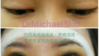 內眼角修復手術—沈筠惇醫師 Dr. Michael 眼整形