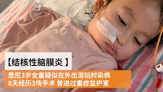 悉尼3岁女童疑外游染结核性脑膜炎 8天3场手术 曾进重症监护室 | SBS中文