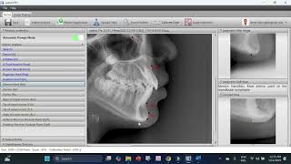 How to use AutoCeph Software for Lateral Cephalogram Analysis?