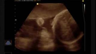 Ultrasound Ian.wmv