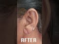 Earlobe / Hole Repair By Ear Pasting lotion / Ear Repair/ Torn Ear lobe Repaired Earlobe -9687889595