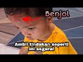 Cara hilangkan benjol kepala akibat terhantuk/ terjatuh