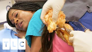 Woman Sings While Dr Lee Removes Her "Talkative" Lipoma | Dr. Pimple Popper Pop Ups