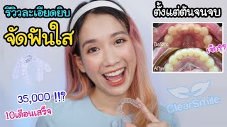 รีวิวจัดฟันใสหลักหมื่น Clear Smile ตั้งแต่ต้นจนจบละเอียดยิบ ดี-ไม่ดี? ถอนฟัน? - Unfull Ice