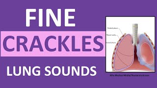 Crackles (Fine) Lung Sounds | Crackles and Rales Breath Sounds Abnormal