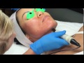 Derpamen Procedure - Avalon Laser - Dr. Reza Tirgari