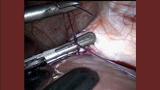 Severe problems encountered during laparoscopic liver and pancreas surgery: How to overcome