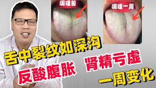 【舌诊案例】舌中裂纹如深沟，反酸腹胀，肾精亏虚，一周明显改善   【舌诊案例分析】