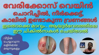 041 |Varicose vein ഉണങ്ങാത്ത കാൽ വ്രണങ്ങൾ: ആയുർവേദ ചികിത്സ എങ്ങനെ ? ചില  പൊടിക്കൈകളും മാർഗ്ഗങ്ങളും