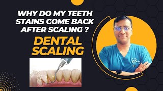 Dr Rudra Mohan | Unmasking the Mystery: Why Tooth Stains Return After Professional Dental Cleaning |