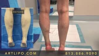 Ankles, Cankles, Calves, Knees | The Best Liposuction | Tampa, Florida, USA - 7 | Expert Dr. Su