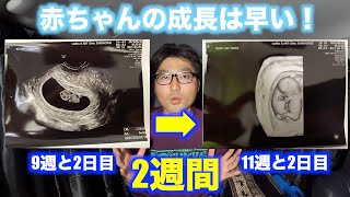 【妊婦の夫】定期検診11週目2日 もう人の形しています　赤ちゃんの成長は早い！