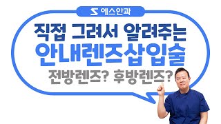 렌즈삽입술 고민중?! 안과전문의가 그려서 알려주는 안내렌즈삽입술