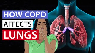 How COPD affects lungs | ശ്വാസകോശത്തെ ബാധിക്കുന്ന വില്ലൻ, ഈ രോഗത്തെ കരുതിയിരിക്കണം | Arogyam