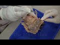 DISSECTION OF URINARY BLADDER #mbbs #neet #medical  #aiims #nursing #viral