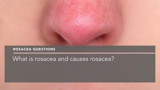 What is rosacea and what causes rosacea?