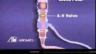 BiVentricular Support System overview 1