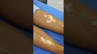 Best Vitiligo Treatments and Amazing Results at Skinaa Clinic #viral #shorts