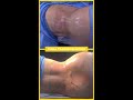 transgender 360° transformation care before after results liposuction hourglass shorts