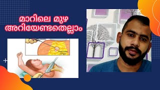 Breast Cyst ക്യാൻസർ ആണോ??എങ്ങനെ തിരിചറിയാം??|Causes, Treatment