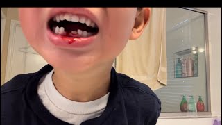 Mom pulls out son’s tooth!