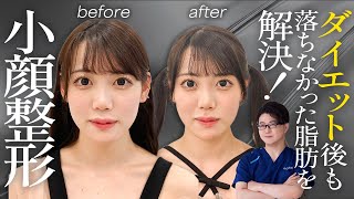 【ダウンタイム最小限】ダイエットでも落ちなかったお顔の脂肪を1day小顔®︎で即日解消！