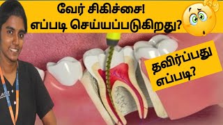 பல் வேர் சிகிச்சை எப்படி செய்யப்படுகிறது? தவிர்ப்பது எப்படி? How tooth root canal treatment is done?