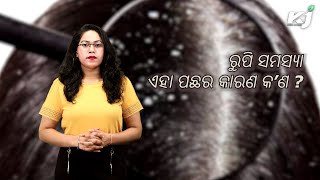 ରୁପି ସମସ୍ୟା : ଏହା ପଛର କାରଣ କ’ଣ ? Dandruff Symptoms Causes