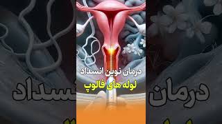 doctortaskin🌟 درمان غیرجراحی انسداد لوله‌های فالوپ: راحت، بی‌درد و مؤثر! 🌟