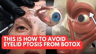 Avoid Eyelid Ptosis From Botox Treatments with THIS Anatomy Knowledge