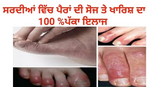 #feetSwelling ਪੈਰਾਂ ਦੀ ਸੋਜ ਤੇ ਖਾਰਿਸ਼ ਦਾ 100 %ਪੱਕਾ ਘਰੇਲੂ ਇਲਾਜ, Swelling feet problem in winter,