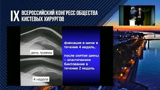 Меркулов М.В.: переломо-вывихи средних фаланг трехфаланговых пальцев.