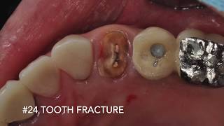 [DENTIS Implant] #24 Extraction and Implant surgery with SQ Guide KIT